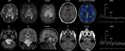 Pediatric diffuse midline glioma H3K27- altered: A complex clinical and biological landscape behind a neatly defined tumor type